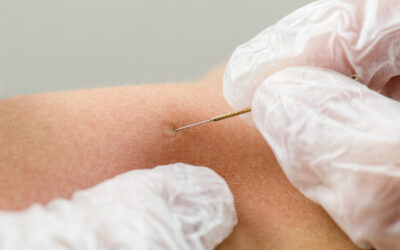 Three Benefits of Dry Needling: A Minimally Invasive Path to Pain Relief