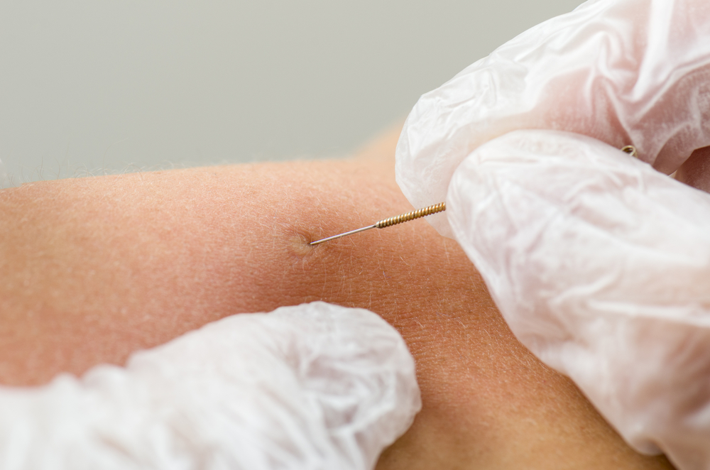 benefits of dry needling