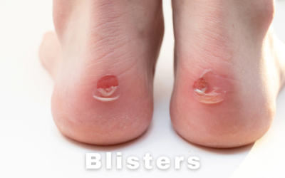 Blisters: How to Prevent & Treat Like a Pro